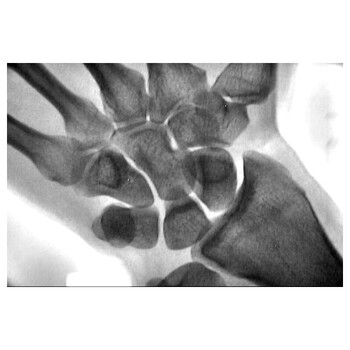 深圳手提式X光机供应适用于骨龄检测
