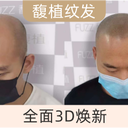 紋發(fā)和植發(fā)兩個有沖突嗎？怎么選擇？